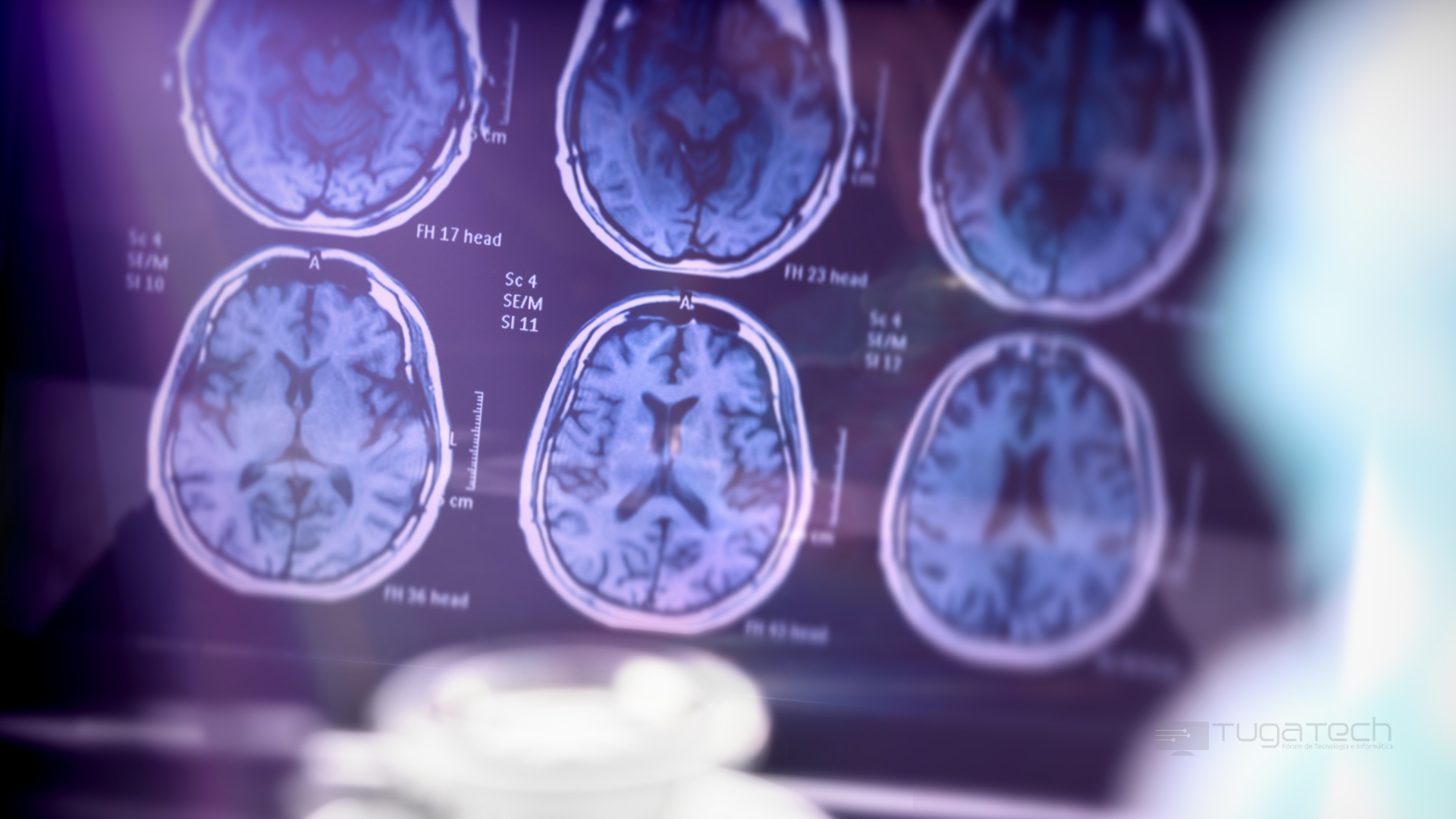 Doença de Alzheimer com imagens de scan na parede